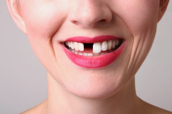 5 Reasons You Should Replace Your Missing Teeth