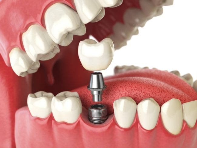 What Are the Different Types of Dental Implants?