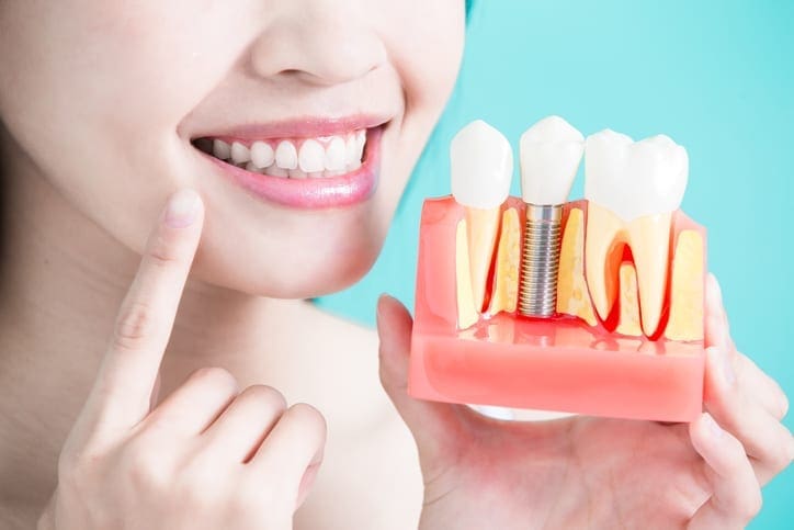 5 Reasons People Choose Dental Implants